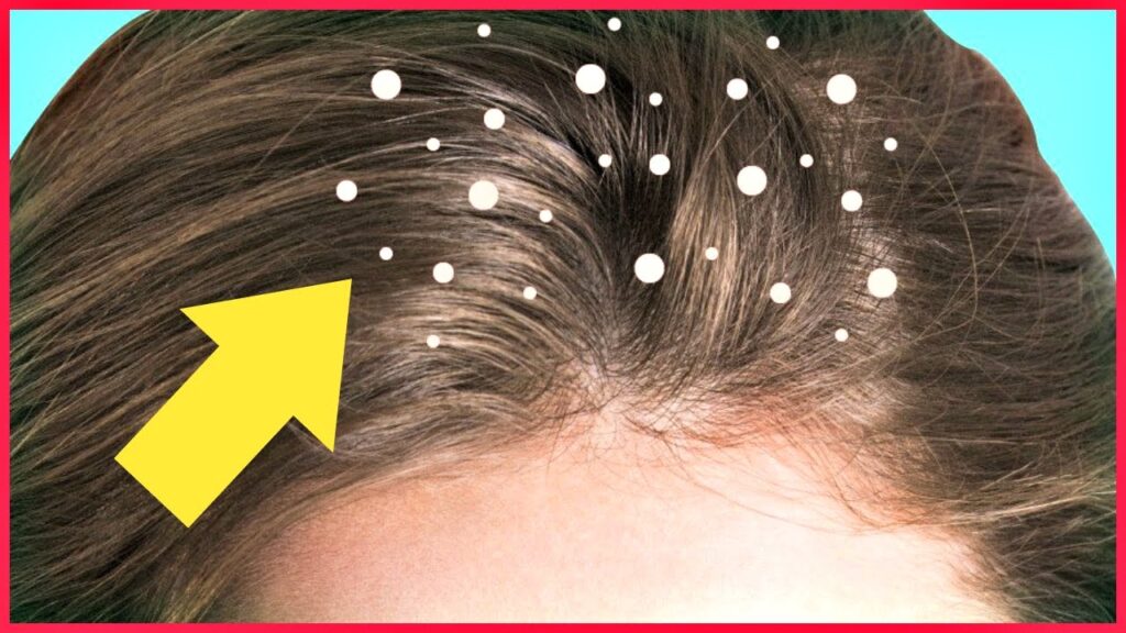 Dandruff:  Natural ayurvedic home remedies for dandruff